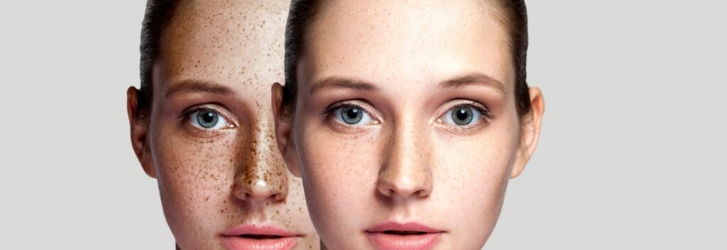 Freckles Treatment in Perth CBD